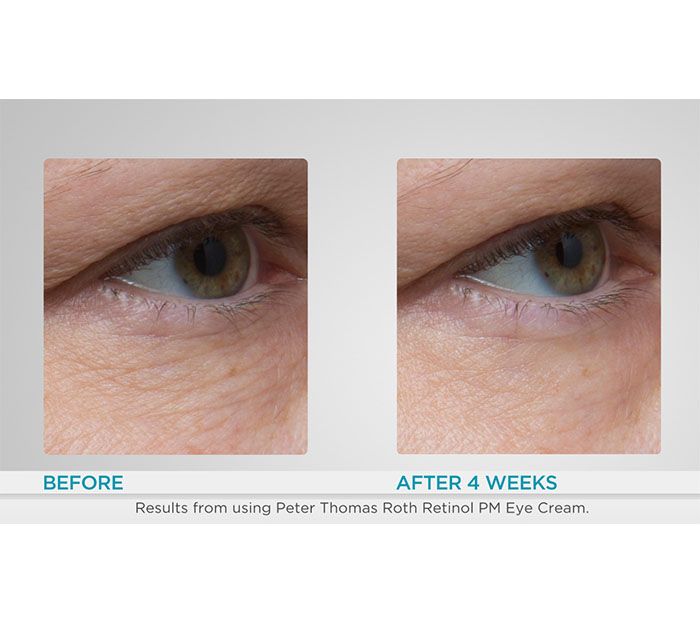 Peter Thomas Roth Super-Size Retinol Fusion Eye Cream — View 4