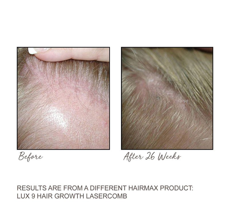 Hairmax Ultima 12 Hair Growth Laser Comb — View 7