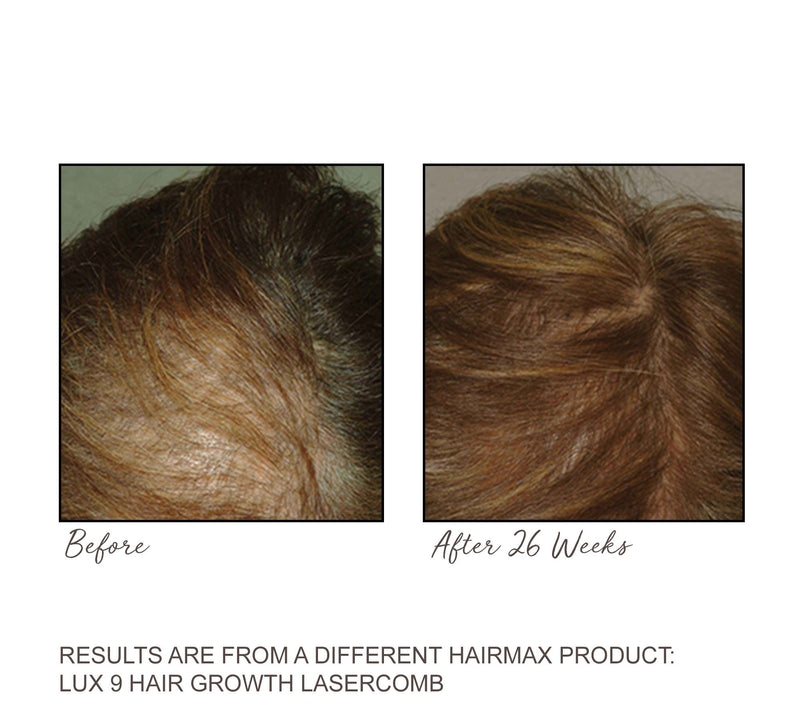 Hairmax Ultima 12 Hair Growth Laser Comb — View 6
