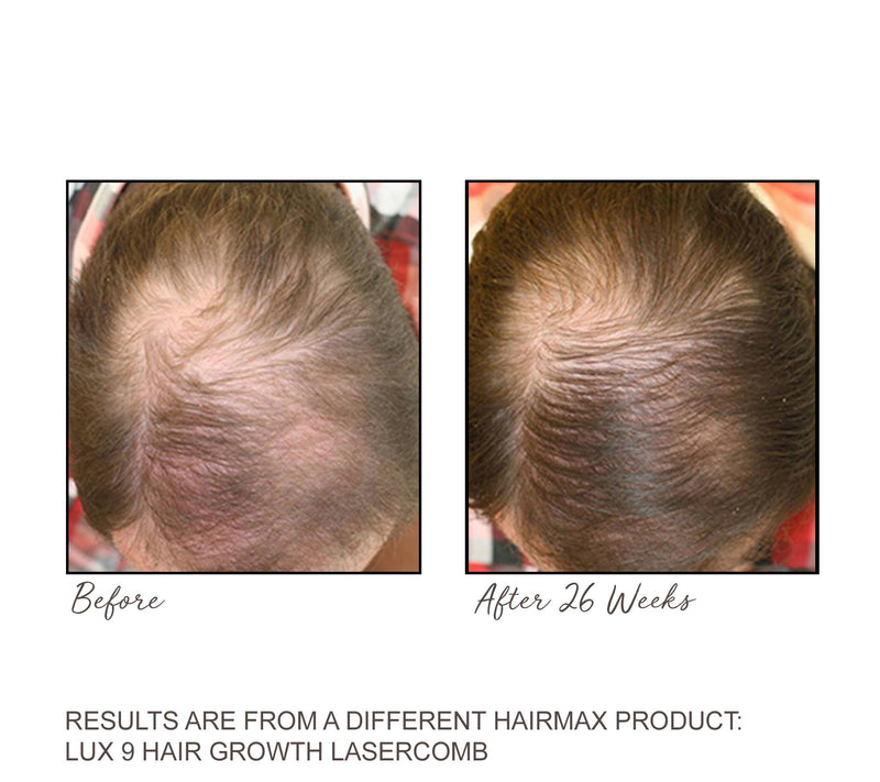Hairmax Ultima 12 Hair Growth Laser Comb — View 5