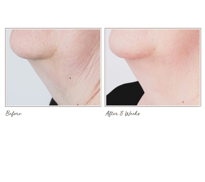Perricone MD Cold Plasma+ Sub-D Neck Treatment 2oz — View 4