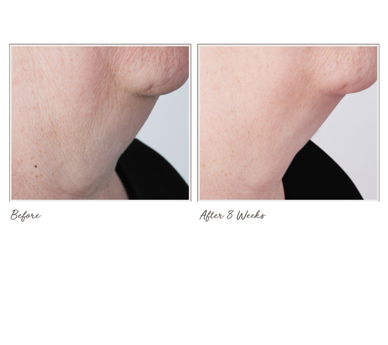 Perricone MD Cold Plasma+ Sub-D Neck Treatment 2oz — View 7