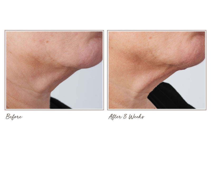 Perricone MD Cold Plasma+ Sub-D Neck Treatment 2oz — View 5