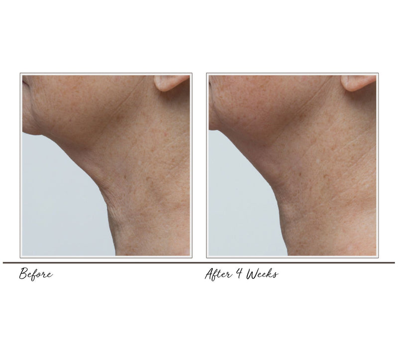 MicrodermMD by Trophy Skin Microderm- abrasion System — View 13