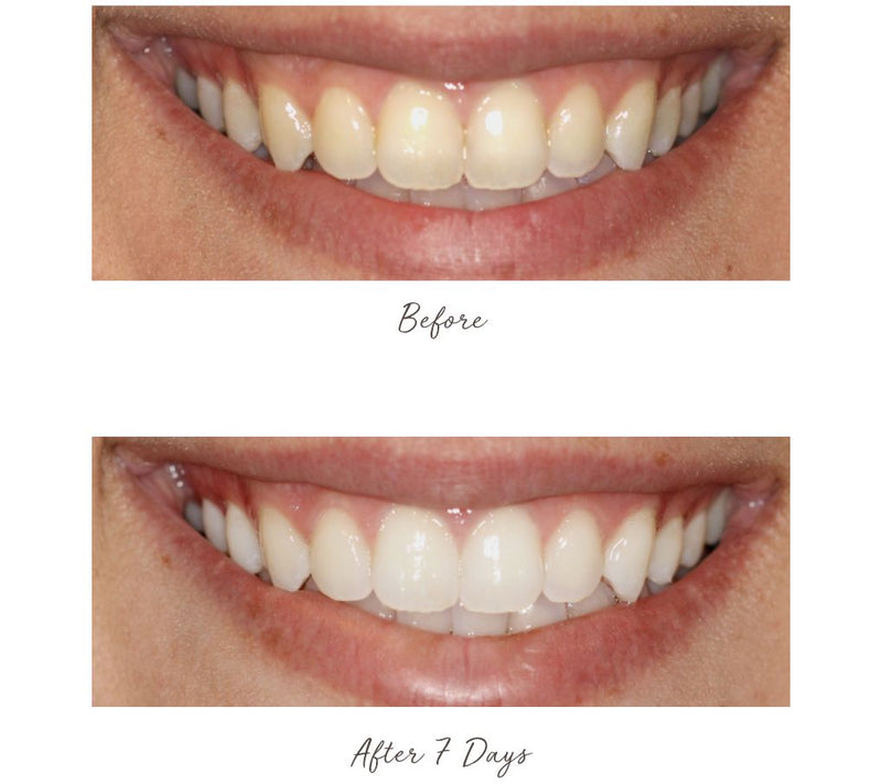 Smileactives Advanced Whitening Pens Duo — View 8