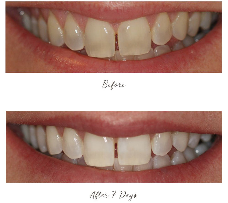 Smileactives Advanced Whitening Pens Duo — View 10