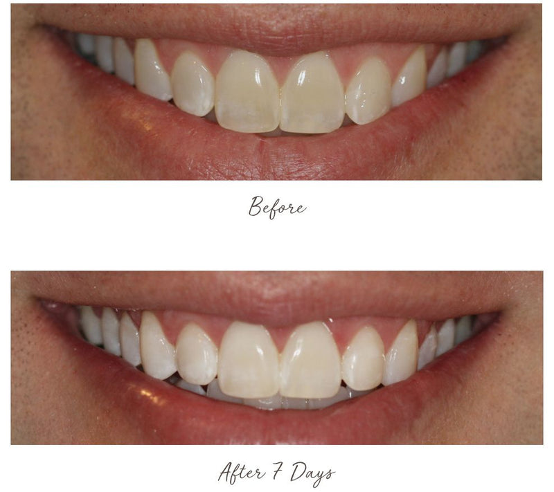 Smileactives Advanced Whitening Pens Duo — View 7