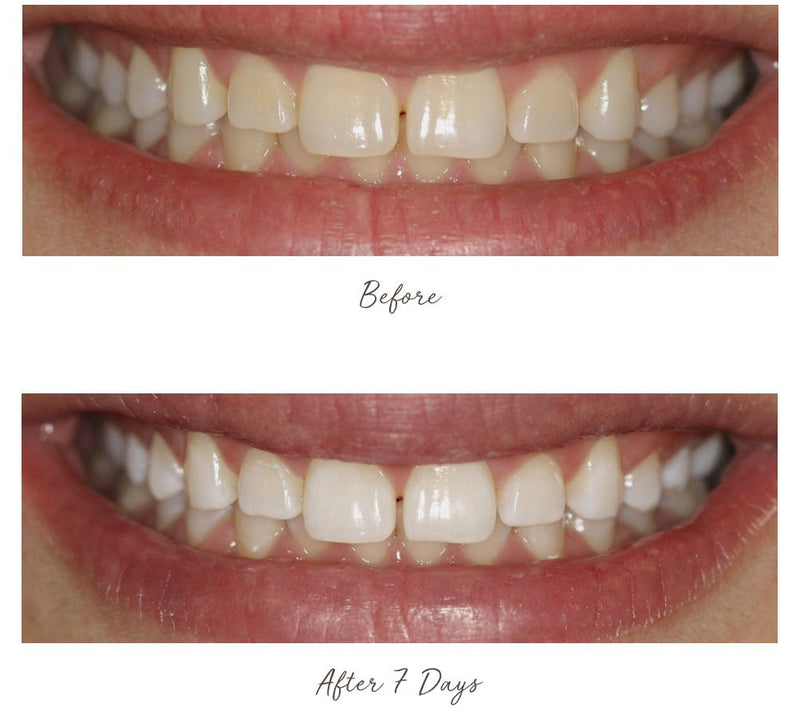 Smileactives Advanced Whitening Pens Duo — View 9
