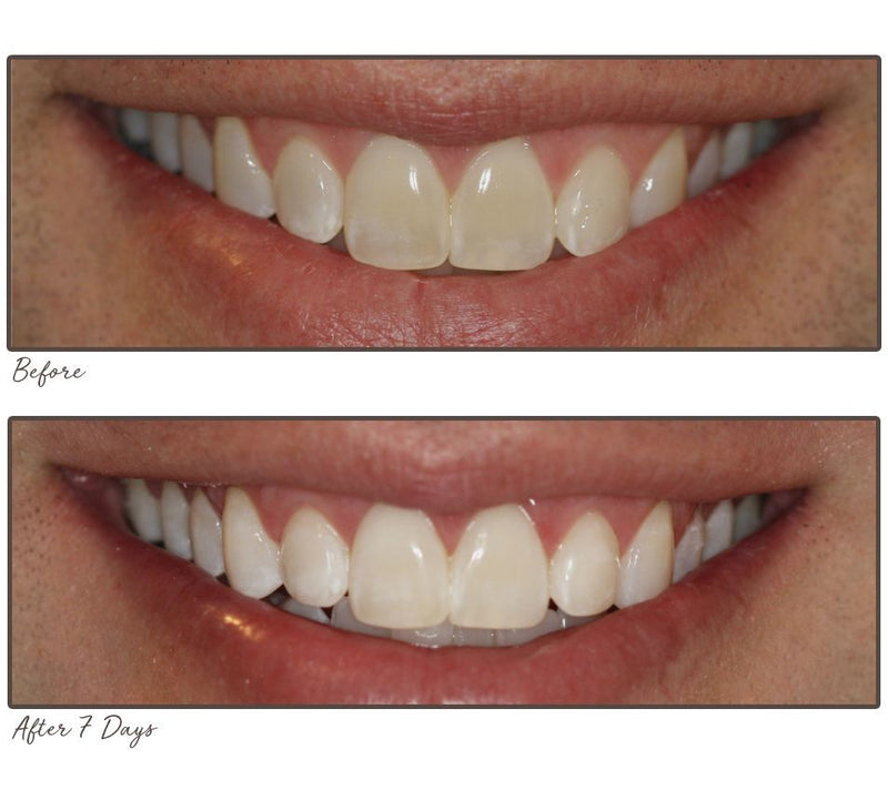 Smileactives Supersize Teeth Whitening Pens Duo — View 6