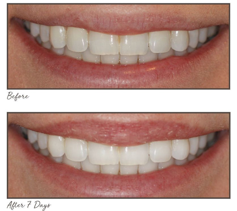 Smileactives Supersize Teeth Whitening Pens Duo — View 5