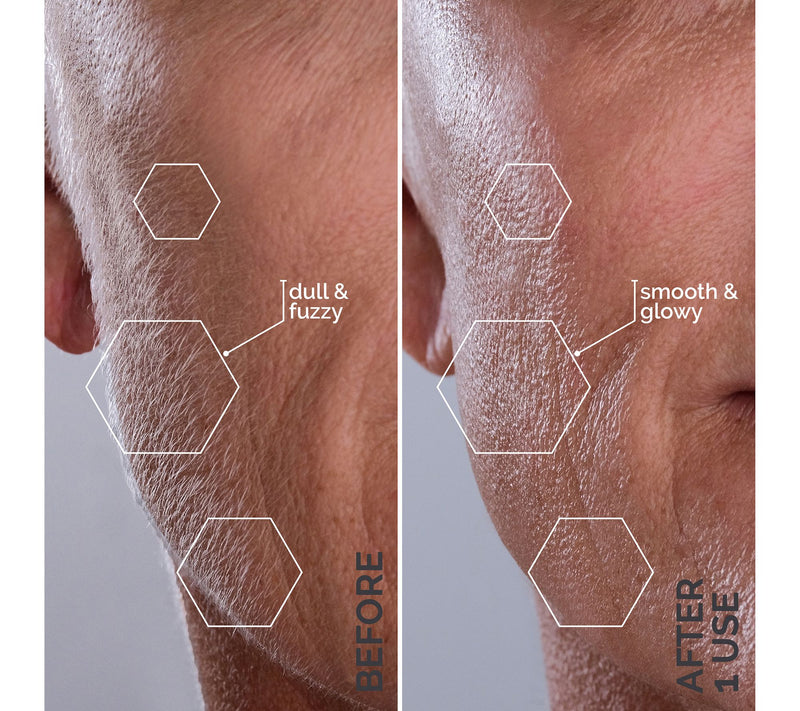 Michael Todd Beauty Sonic Dermaplaning Peach Fuzz Removal — View 10