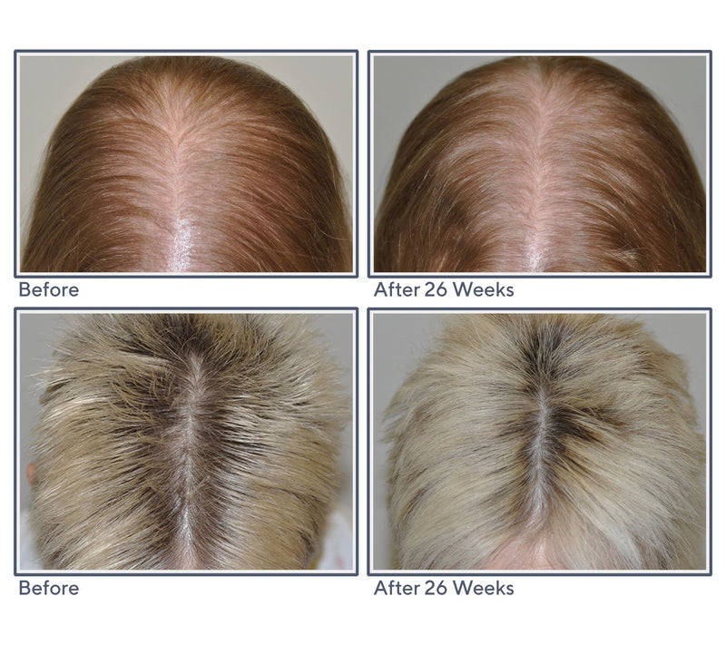 Hairmax Actonis 18 Dual Action LaserComb — View 11