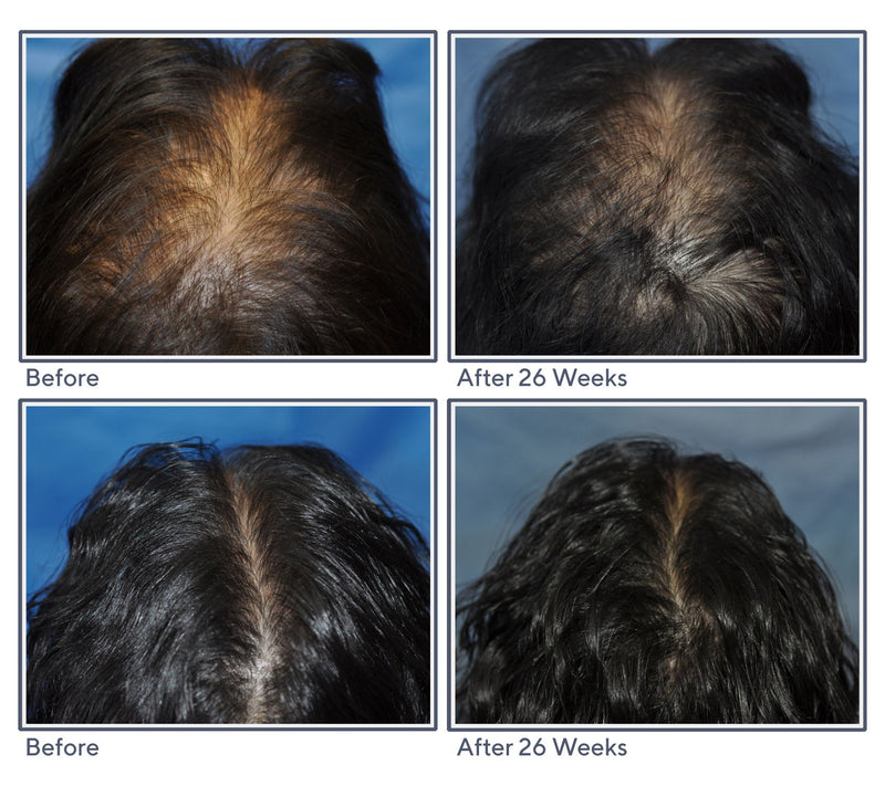 Hairmax Actonis 18 Dual Action LaserComb — View 9