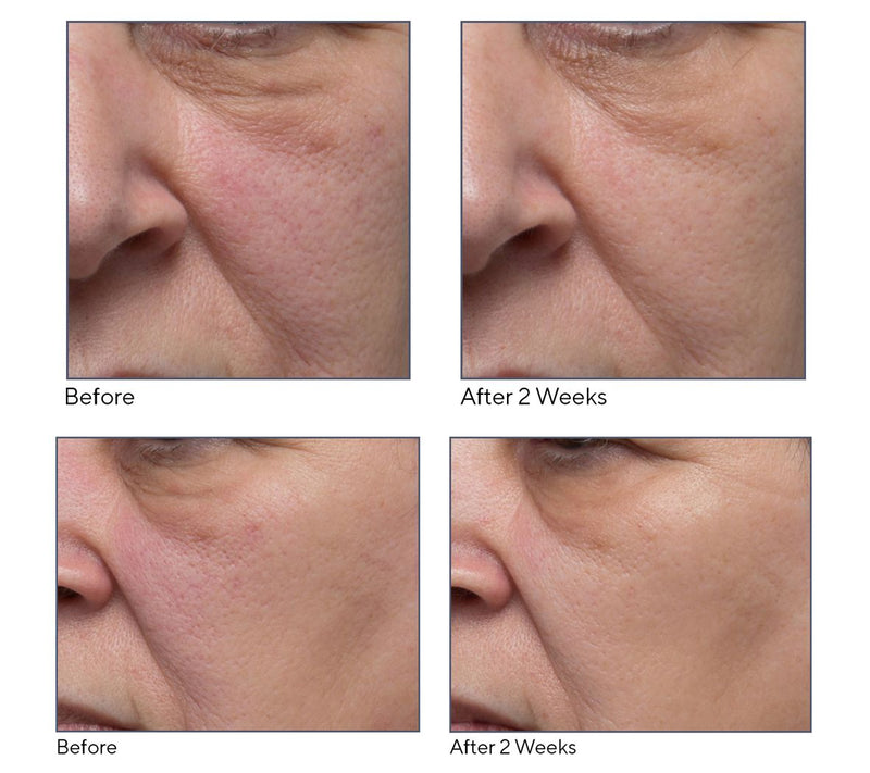 ELEMIS Dynamic Resurfacing Facial Pads & Super-C Serum — View 5