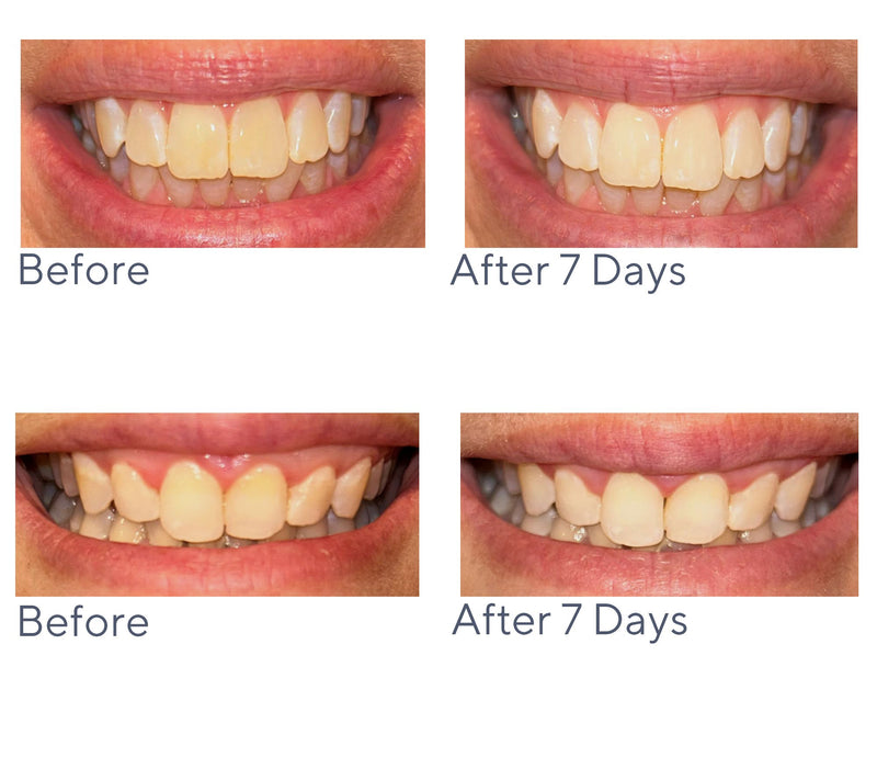 Smileactives Super-Size Pro Teeth Whitening 7.6oz Gel — View 5