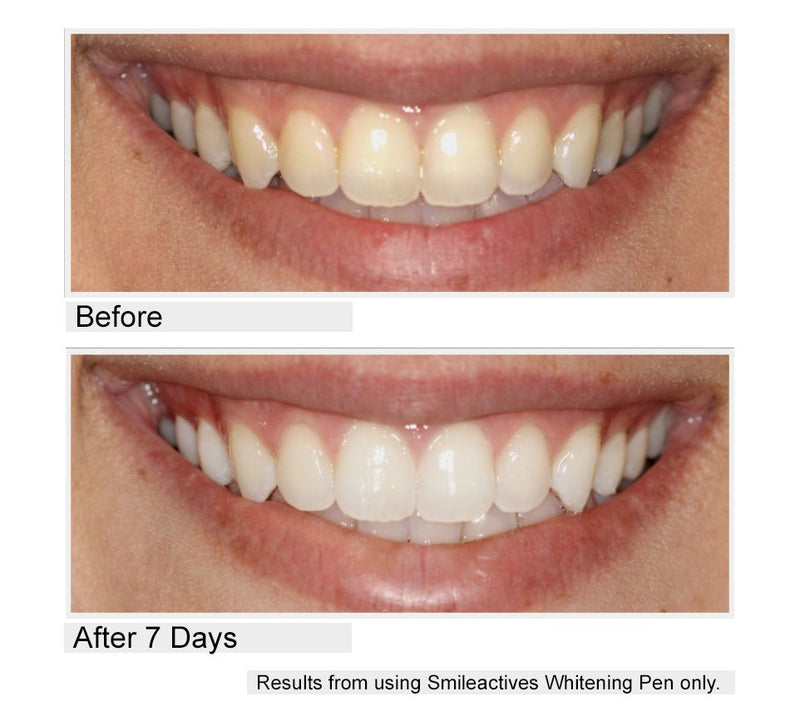 Smileactives CIJ Set of 5 Teeth Whitening Pens — View 3