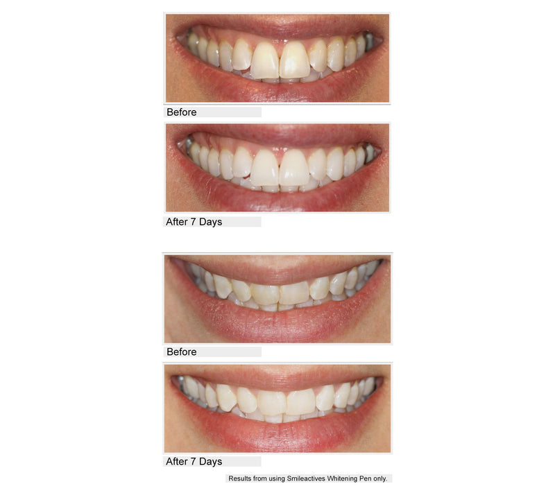 Smileactives CIJ Set of 5 Teeth Whitening Pens — View 5