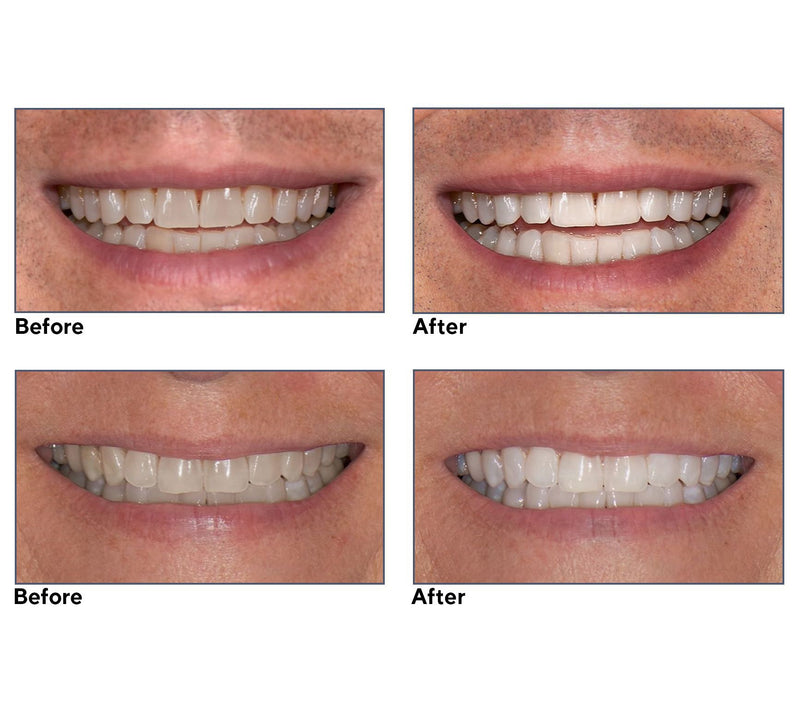 Supersmile Teeth Whitening Superstrips & Quikee 2 pc Set — View 8