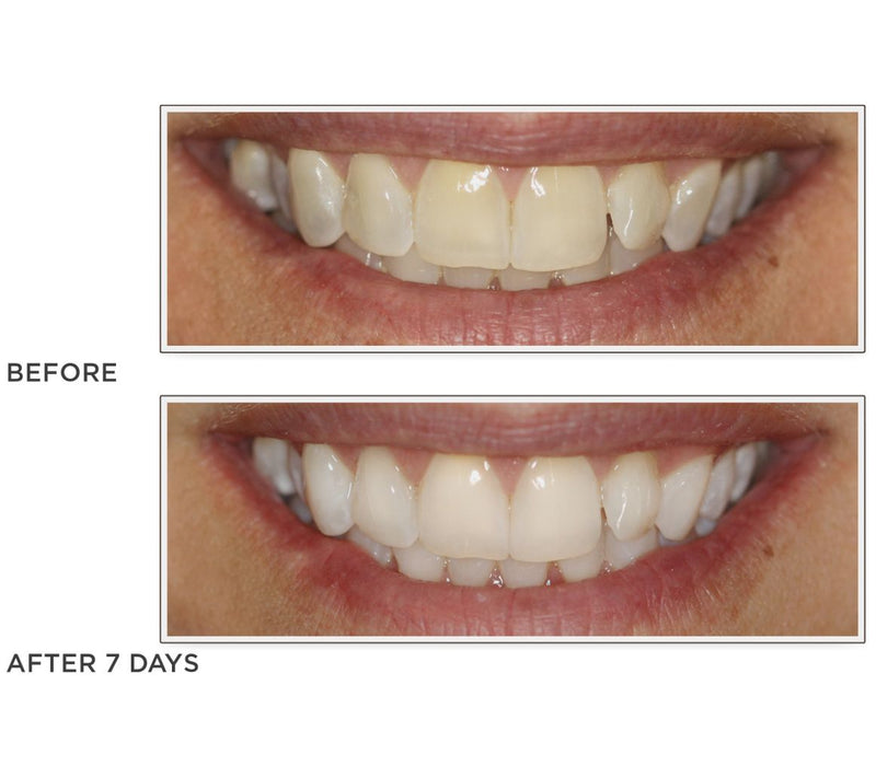 Smileactives Set of 3 Teeth Whitening Pens — View 5
