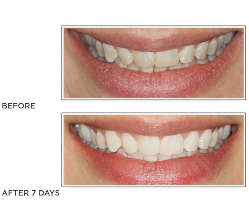 Smileactives Set of 3 Teeth Whitening Pens — View 3
