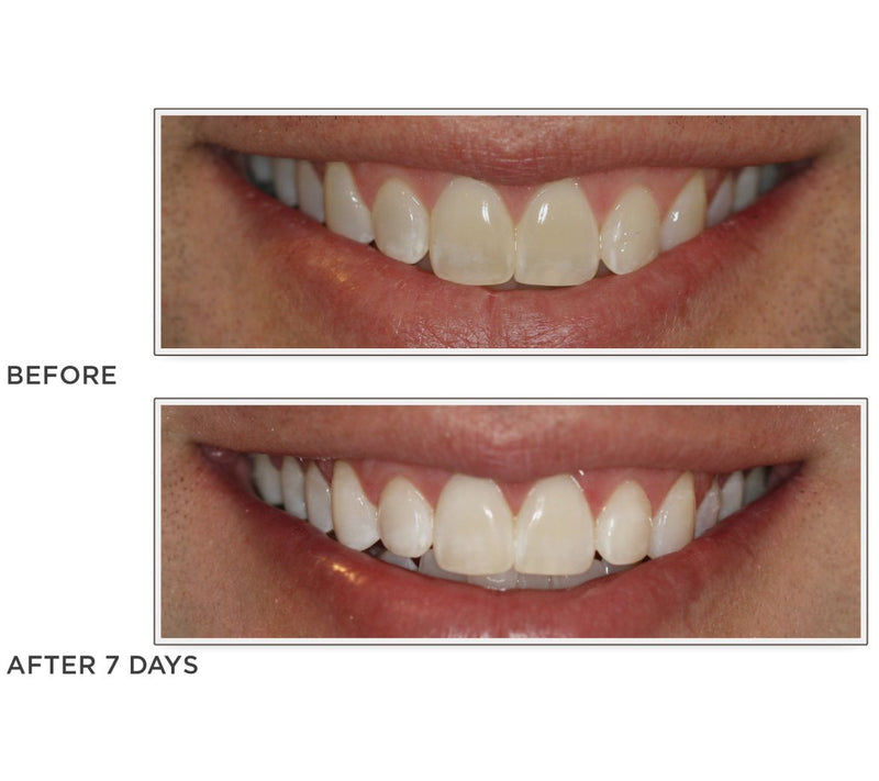 Smileactives Set of 3 Teeth Whitening Pens — View 4
