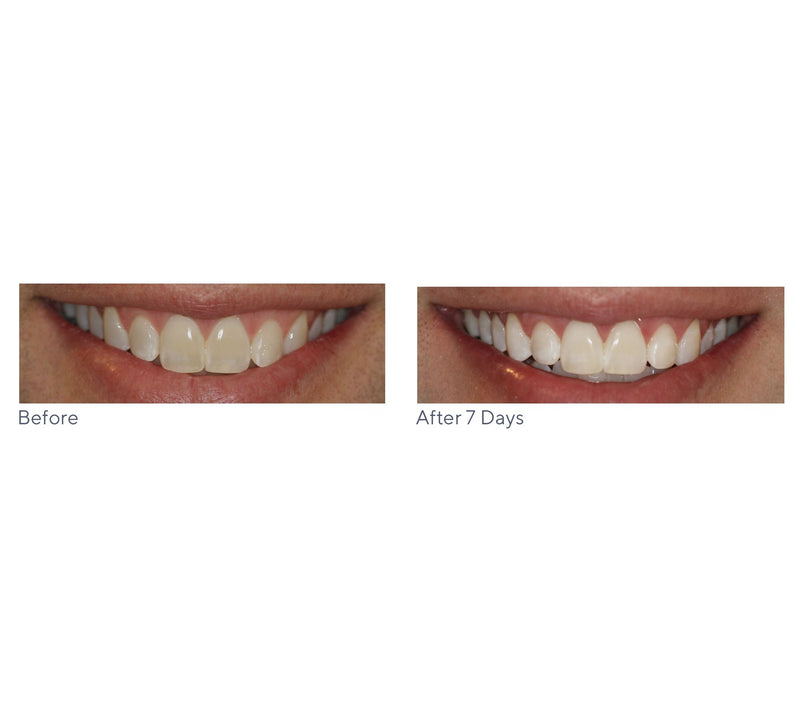 Smileactives Set of 4 Teeth Whitening Pens — View 7