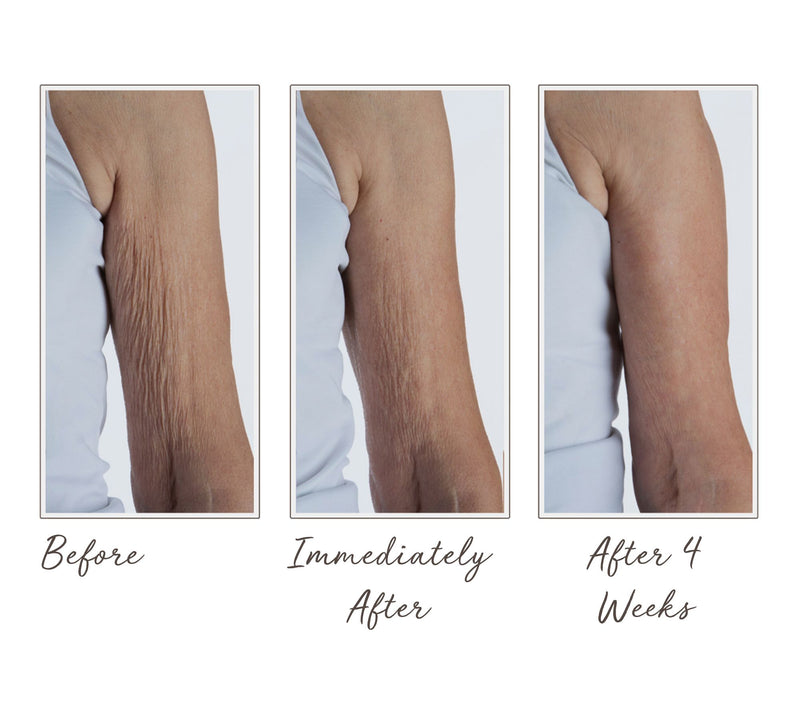 Crepe Erase Body Repair System w/ Body Resurfacing Serum — View 5