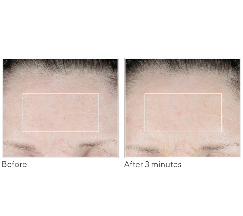 NuFace FIX MicroWand w/ Serum & Power Patches Set — View 6