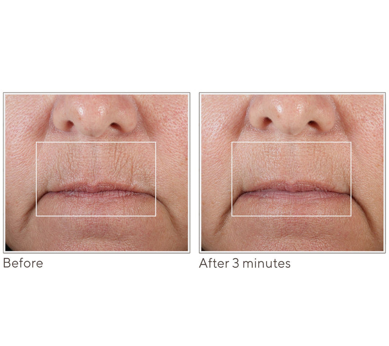 NuFace FIX MicroWand w/ Serum & Power Patches Set — View 7