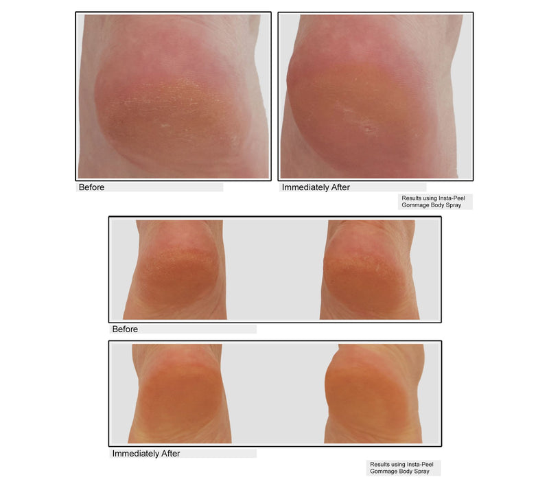 KAPLAN MD Gommage Exfoliating Body Peel Spray Home & Away 2pc — View 2