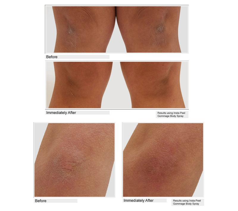 KAPLAN MD Gommage Exfoliating Body Peel Spray Home & Away 2pc — View 5
