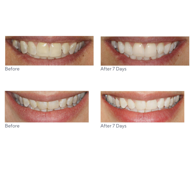 Smileactives Set of 5 Teeth Whitening Pens — View 7