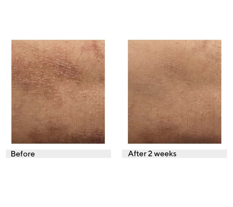 KAPLAN MD Diamond Contour Eczema + Dermatitis Skin Balm — View 4