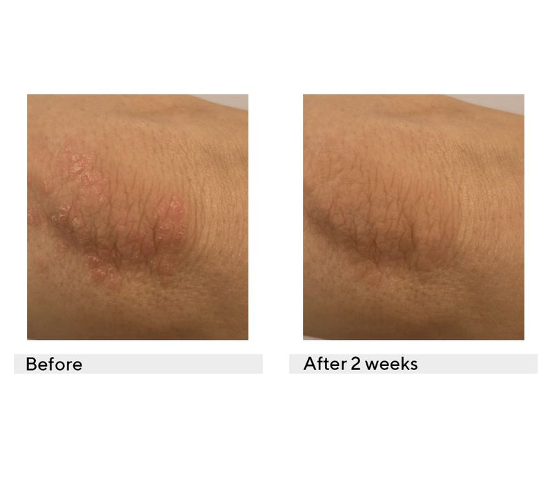 KAPLAN MD Diamond Contour Eczema + Dermatitis Skin Balm — View 3