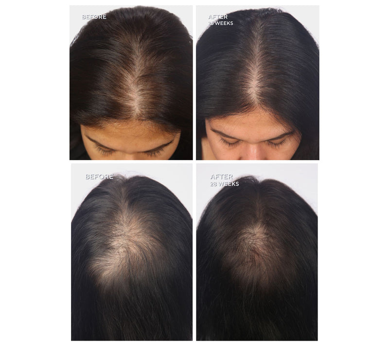 Hairmax LaserBand 82 ComfortFlex Hair Growth Device — View 3