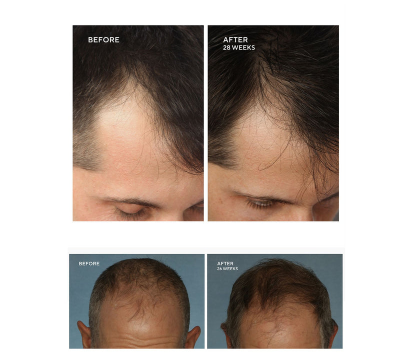 Hairmax LaserBand 82 ComfortFlex Hair Growth Device — View 4