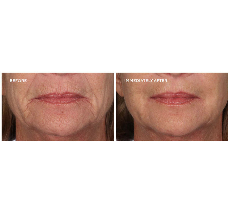 SERIOUS SKINCARE Super-Size Insta-Tox Duo w/Bag — View 8