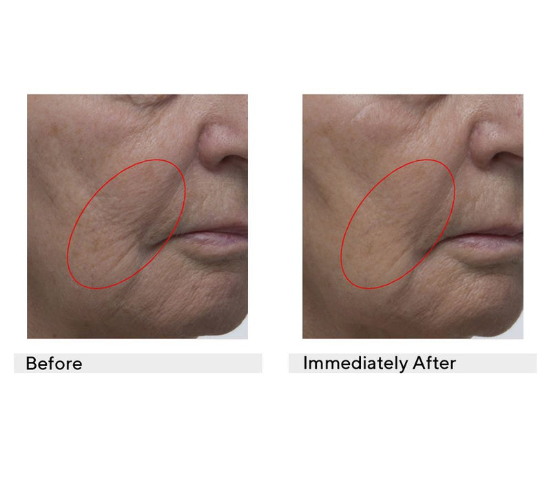 philosophy 1.7oz ultimate miracle worker lifting face & neck serum — View 5