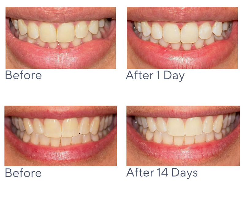 Smileactives Give One/Keep One Pro Whitening Gel 4pc Kit — View 4