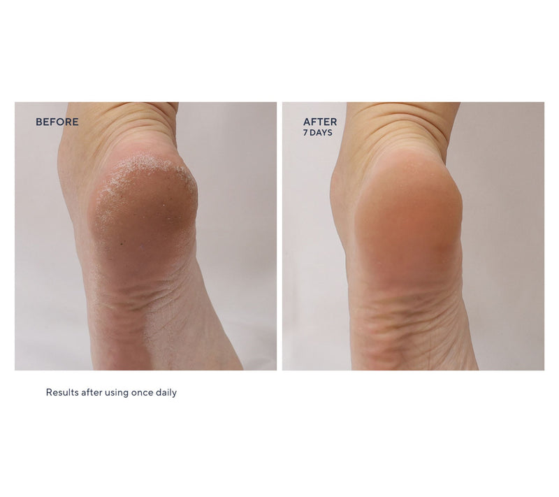 Whish Mega 13oz Exfoliating Foot Mask w/ 2.5oz & Socks — View 4