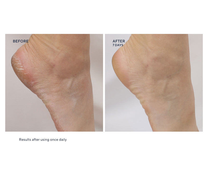 Whish Mega 13oz Exfoliating Foot Mask w/ 2.5oz & Socks — View 5