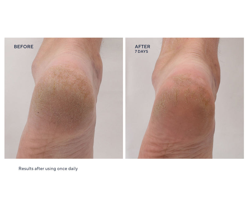 Whish Mega 13oz Exfoliating Foot Mask w/ 2.5oz & Socks — View 6