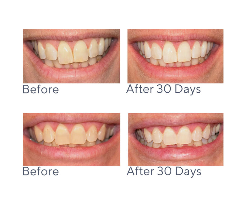 Smileactives Give One/Keep One Pro Whitening Gel Auto-Delivery — View 2