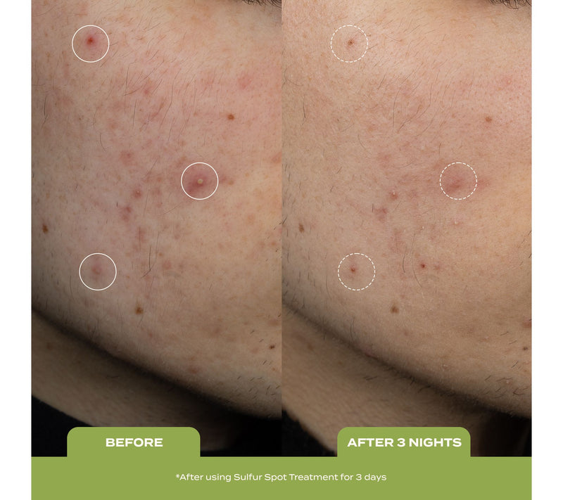 banu skin Acne Clearing System for Acne-Prone Skin — View 6