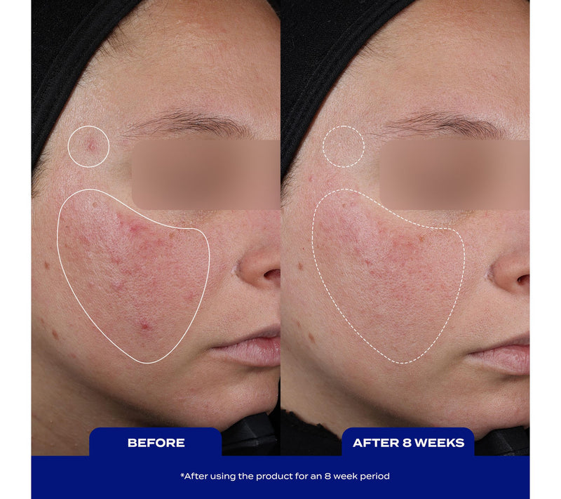 banu skin Acne Clearing System for Acne-Prone Skin — View 3