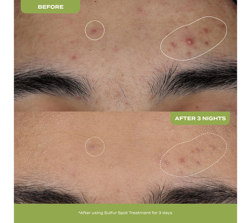 banu skin 10% Sulfur Spot Treatment Duo for Acne — View 2